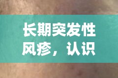 长期突发性风疹，认识、预防与治疗全攻略